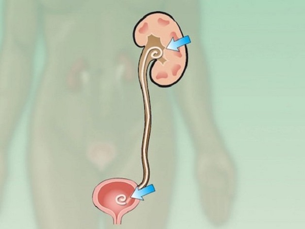 Hẹp niệu quản có nguy hiểm không