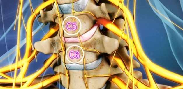 đau cột sống cổ do thoát vị đĩa đệm, thoái hóa