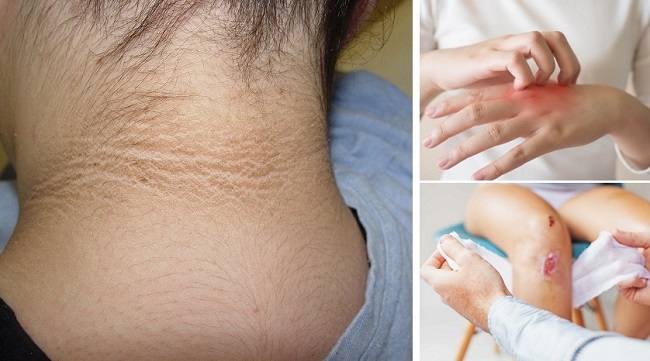 Dấu hiệu tiểu đường type2 