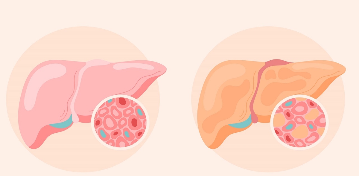 Các phương pháp điều trị gan nhiễm mỡ độ 3 hiệu quả nhất