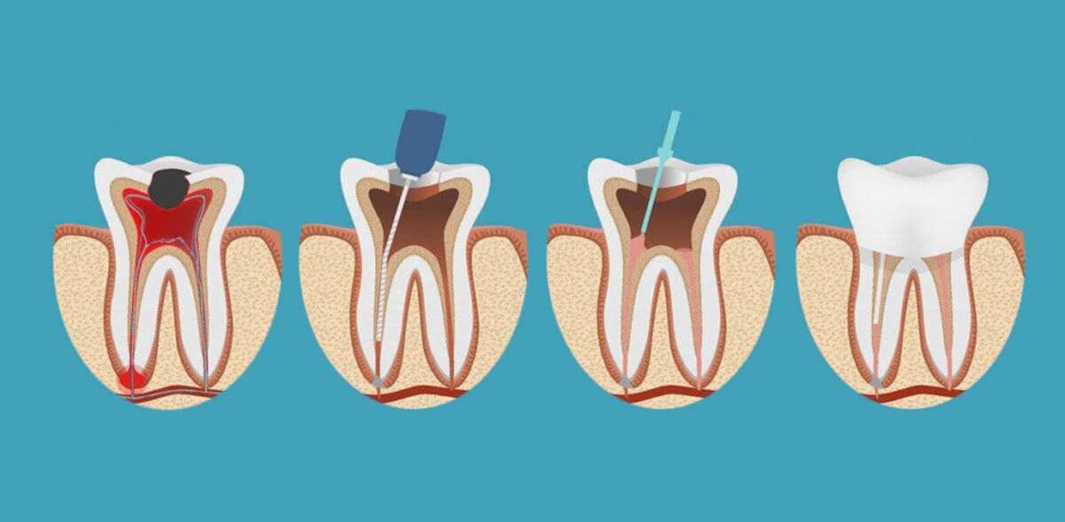 Tìm hiểu nguyên tắc điều trị tủy răng