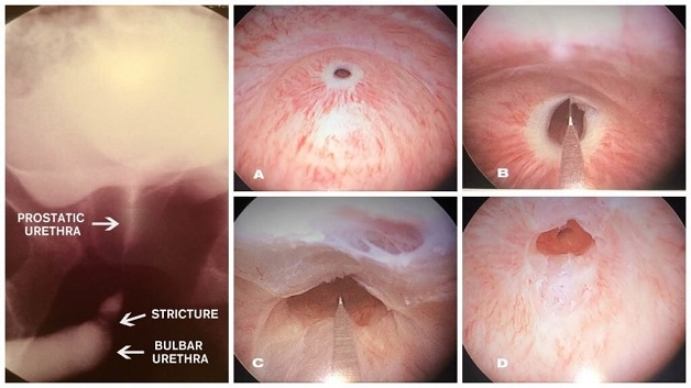 hẹp niệu quản