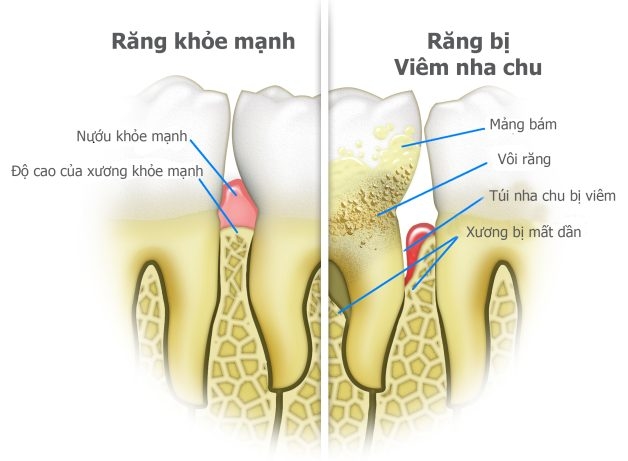 lợi bị sưng