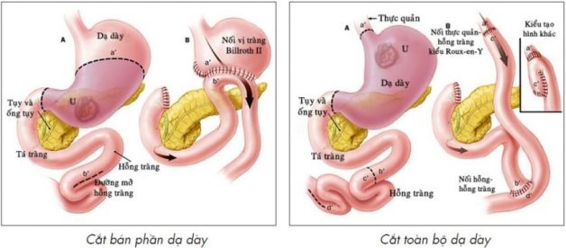 Minh họa hai vị trí cắt viêm loét dạ dày