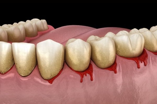 Cao răng gây ra tình trạng sâu răng, viêm lợi, viêm nha chu, hôi miệng, thậm chí là có thể gây ra một số bệnh lý toàn thân