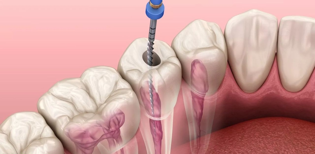 Phương pháp điều trị tủy răng tại nha khoa hiện nay
