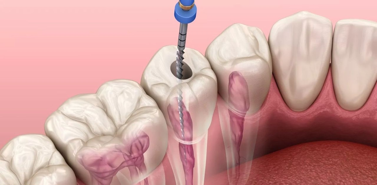 Phương pháp điều trị tủy răng tại nha khoa hiện nay