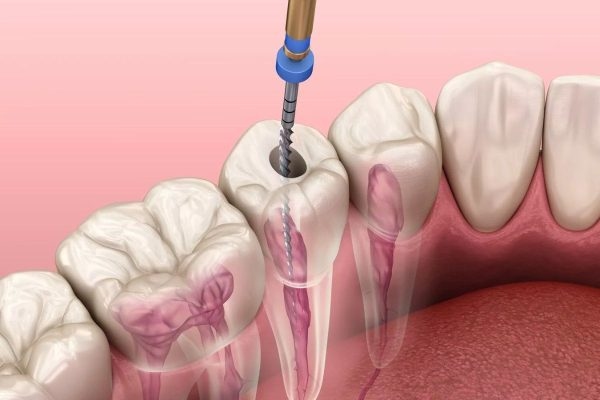 Điều trị tủy là thủ thuật bảo tồn răng bằng việc loại bỏ hết tủy răng bị viêm nhiễm, chết tủy