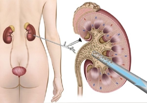 Tìm hiểu phương pháp tán sỏi ngoài cơ thể và tán sỏi qua da