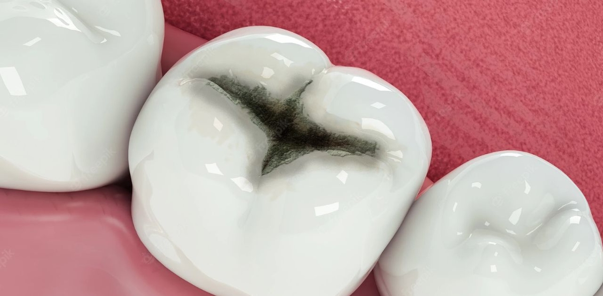 Giải đáp: Răng sâu có phục hồi được không?