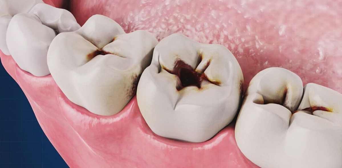 Sâu răng lâu năm có ảnh hưởng gì không?