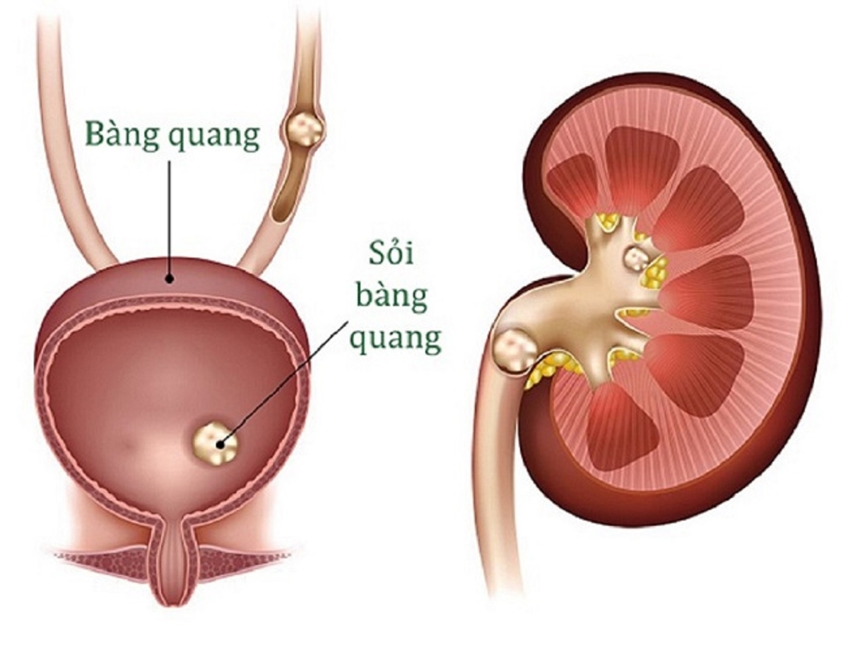 Giải đáp: sỏi bàng quang 5mm có nguy hiểm không?
