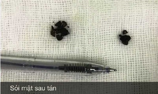 tán sỏi mật