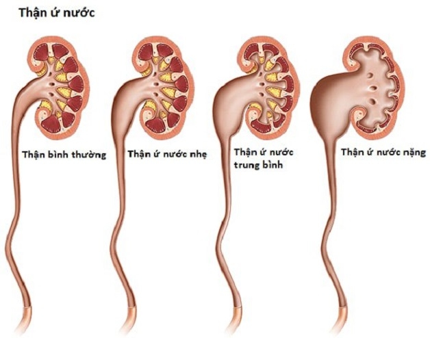 Biến chứng của bệnh hẹp niệu quản 