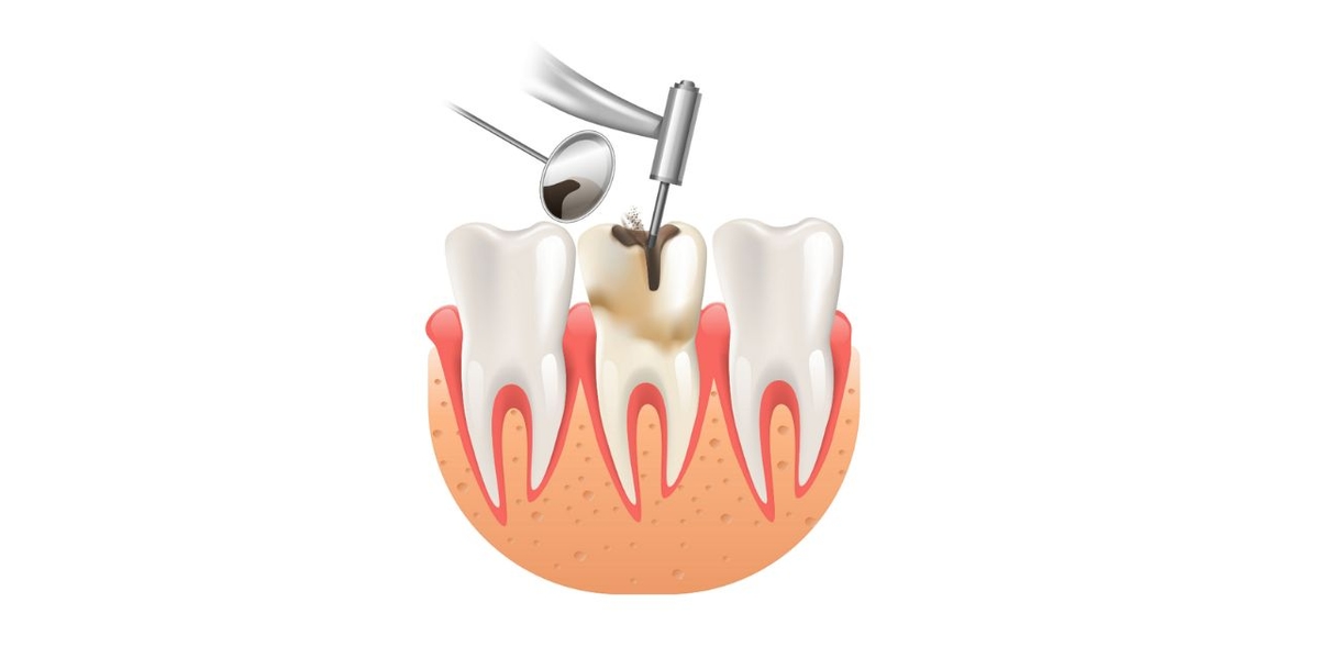 Thời gian điều trị tủy răng kéo dài bao lâu?