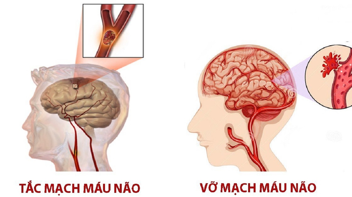 Tai biến: Nhận biết và cách xử trí như thế nào?