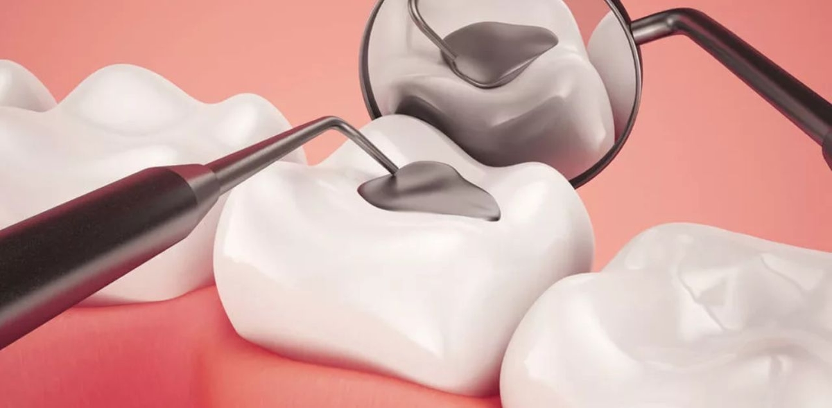 Tìm hiểu về kỹ thuật hàn trám răng sâu