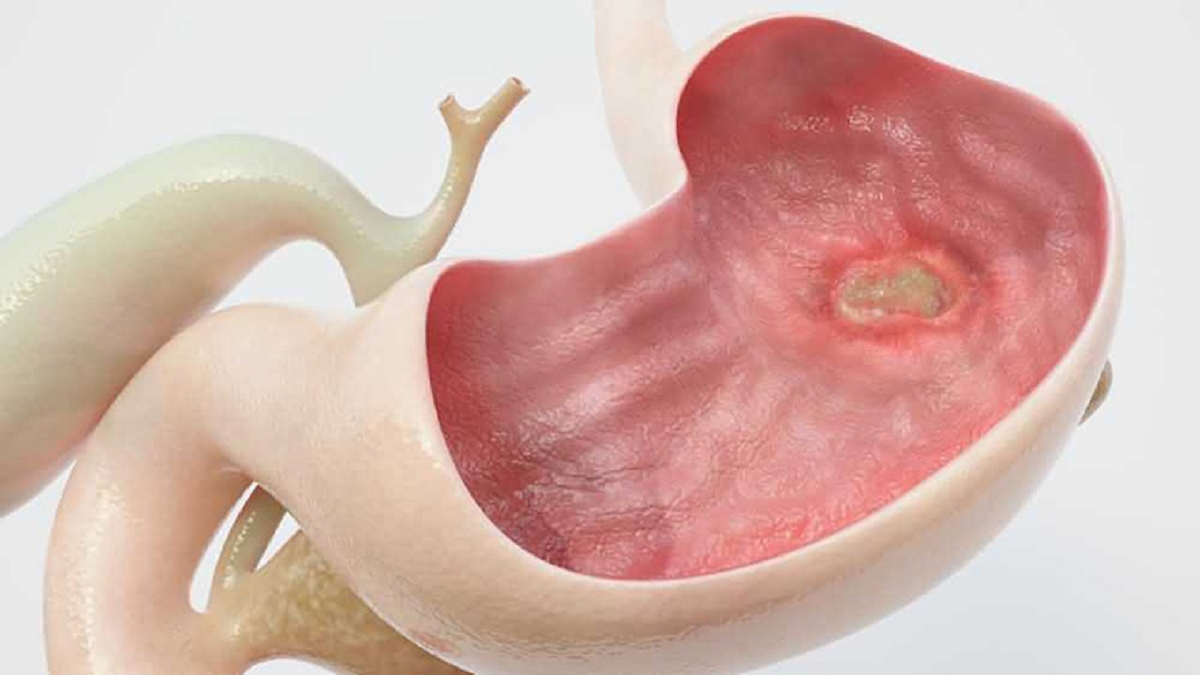 Triệu chứng của loét dạ dày &#8211; Cách điều trị và phòng tránh