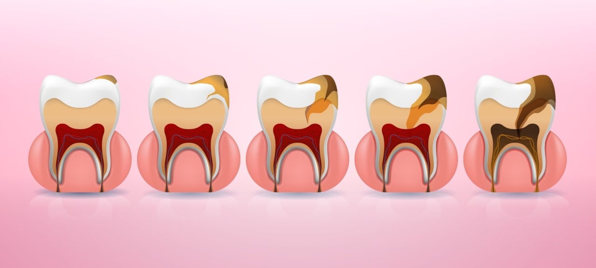 Tất tần tật về vi khuẩn gây sâu răng bạn nhất định phải biết