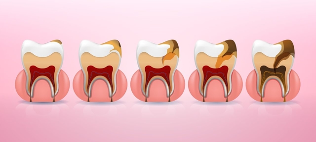 Tất tần tật về vi khuẩn gây sâu răng bạn nhất định phải biết