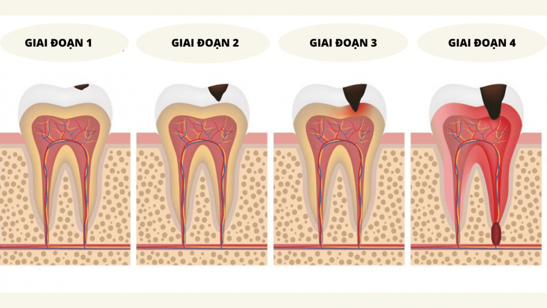 Viêm cuống răng do đâu? Chữa trị như thế nào?