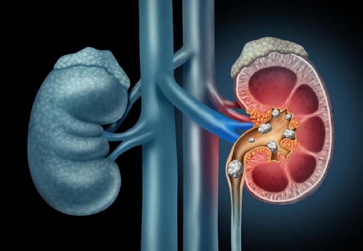 Bắn sỏi thận &#8211; Phương pháp điều trị sỏi hiệu quả