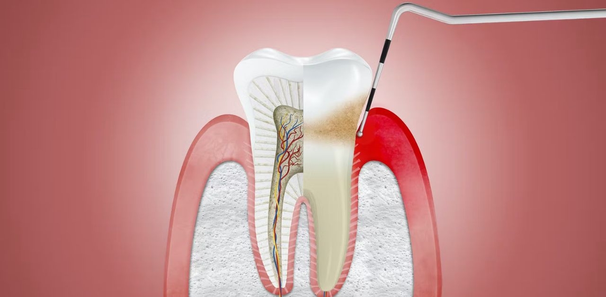 Nhận biết các dấu hiệu của viêm lợi và cách phòng ngừa
