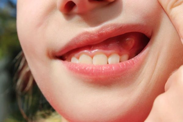 Sưng tấy, đau nhức vùng nướu và chân răng là các dấu hiệu viêm chân răng thường gặp