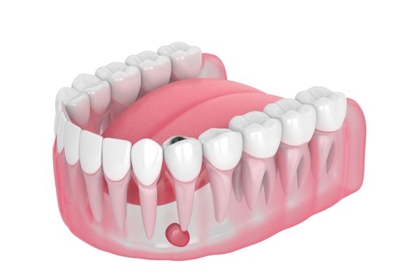 Viêm nhiễm xảy ra ở các tổ chức quanh răng được gọi là viêm chân răng