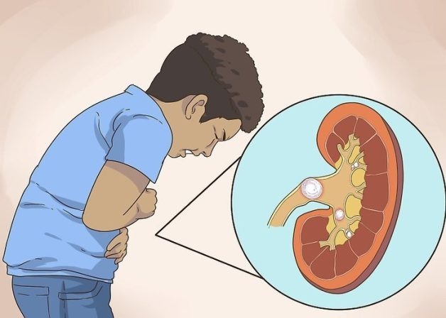 4 phương pháp điều trị tán sỏi tiết niệu
