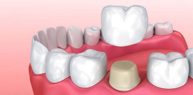 Giải đáp: Điều trị tủy răng có nên bọc sứ không?