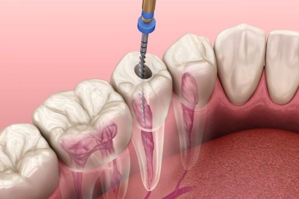 Phương pháp thường được áp dụng để chữa tuỷ chính là hàn trám ống tủy