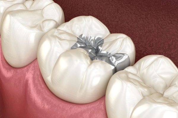 Điều trị tủy giúp khắc phục tình trạng sâu nặng, chấn thương hở tủy, đảm bảo chức năng và thẩm mỹ cho răng
