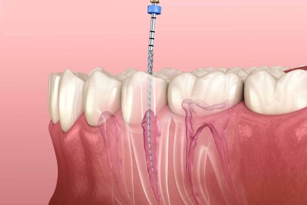 Hàn trám là kỹ thuật giúp bảo toàn các mô răng khỏe mạnh, khắc phục tình trạng viêm tủy răng