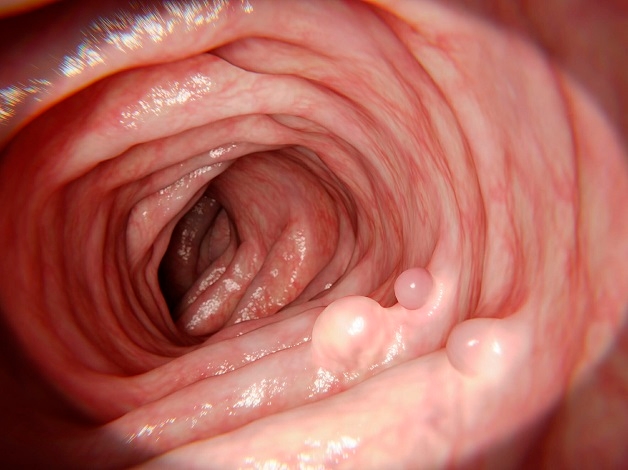 Polyp đại tràng là gì?