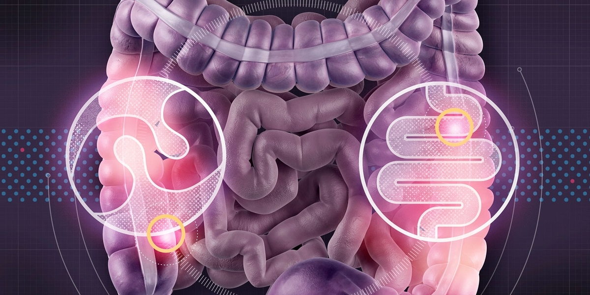 Polyp đại tràng có gây ung thư không? Chẩn đoán và điều trị