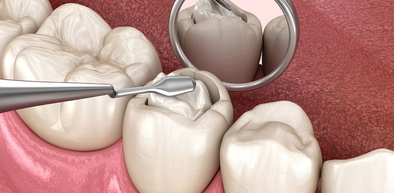 Tìm hiểu quy trình hàn răng từ A đến Z