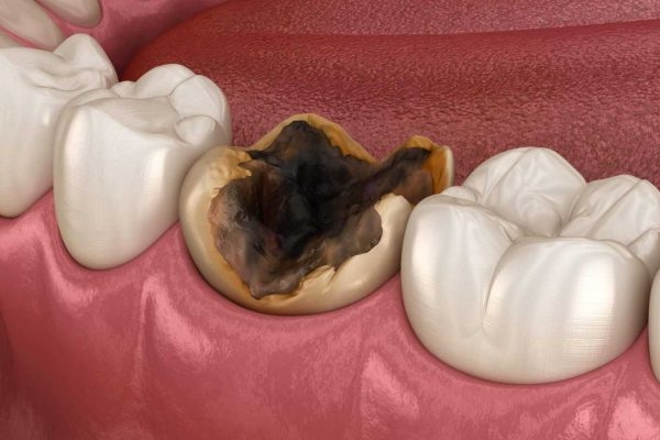 Vi khuẩn có hại phát triển quá mức, gây ra tình trạng sâu răng hàm ở mọi người