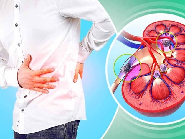 Điều trị tán sỏi thận hết bao nhiêu tiền