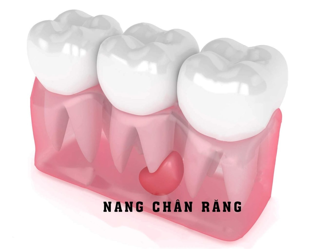 U chân răng: Nhận biết và điều trị