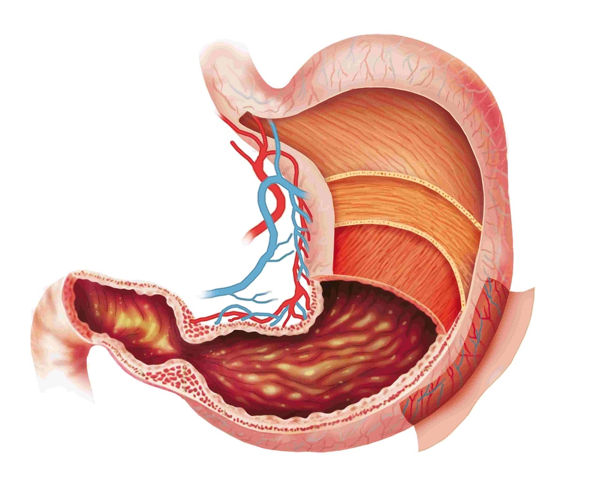 Viêm cấp dạ dày và những điều bạn cần biết
