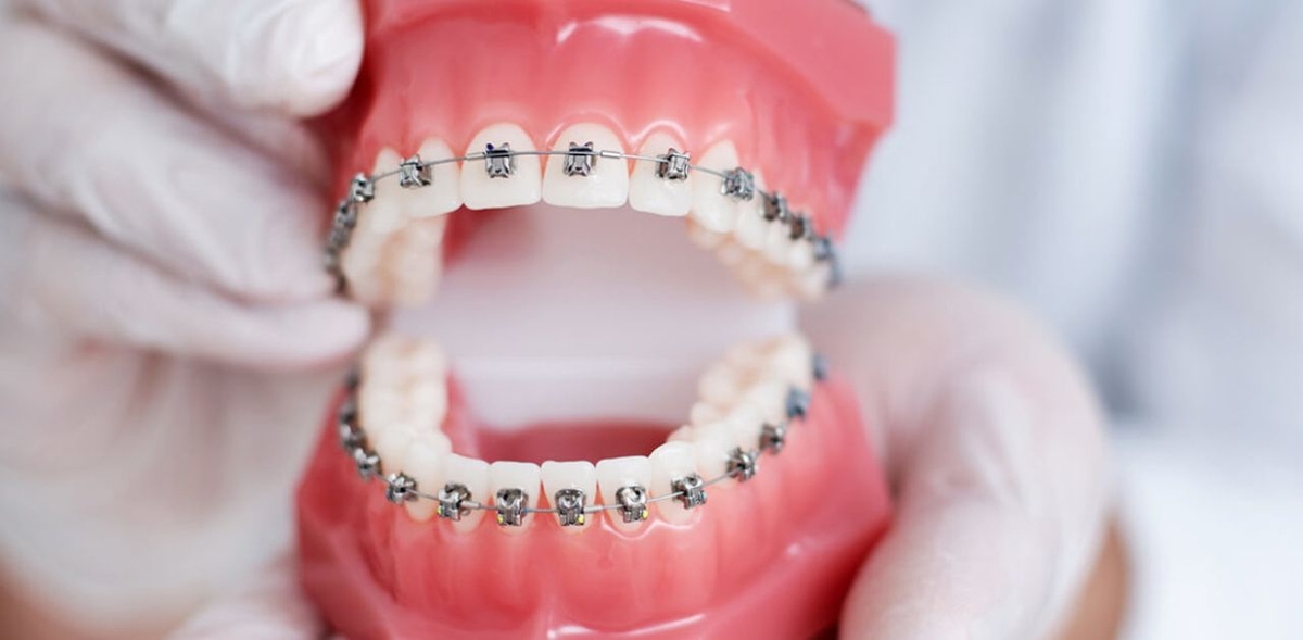 Viêm lợi khi niềng răng: Nguyên nhân và cách điều trị