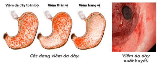 Viêm thân vị dạ dày là bệnh lý tiêu hóa khá phổ biến
