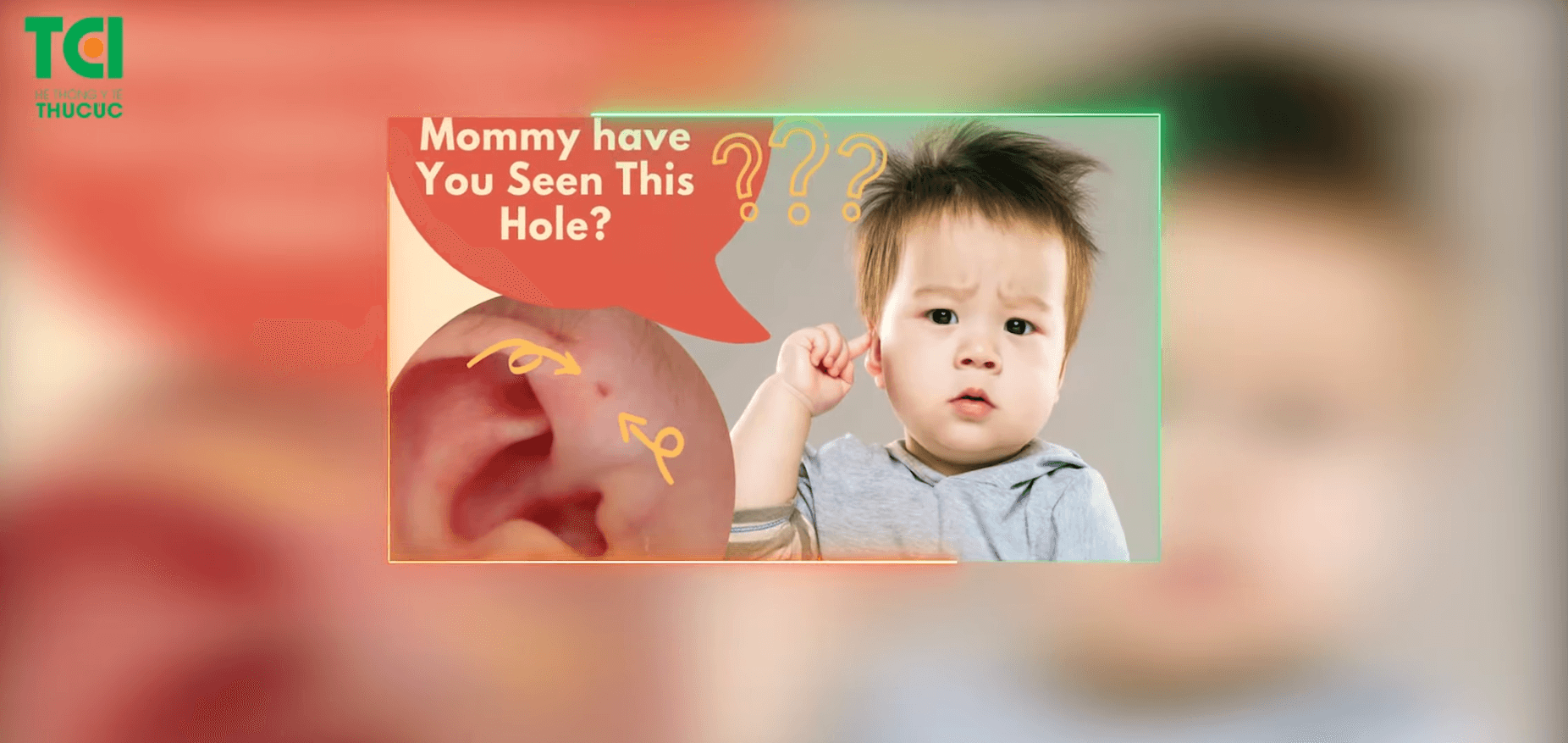 Phẫu thuật lấy lỗ rò luân nhĩ thành công