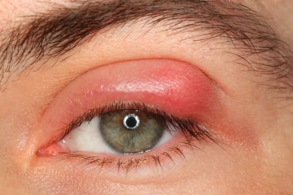 Đau mắt hột là tình trạng viêm kết mạc, giác mạc do vi khuẩn gây ra khiến mắt sưng đỏ, đau và nhạy cảm với ánh sáng