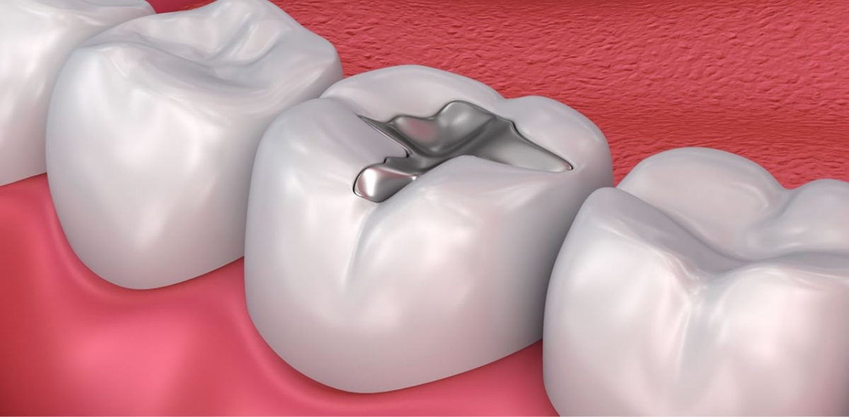 Cách chữa răng hàm bị sâu dứt điểm