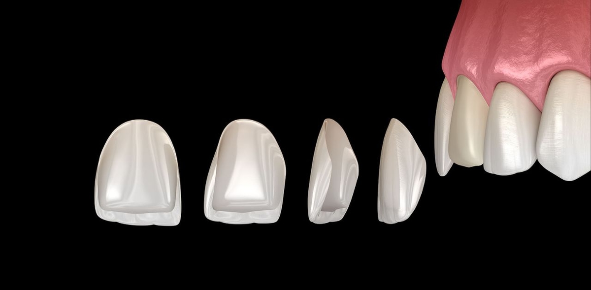 Giải đáp: Có nên dán sứ veneer không?
