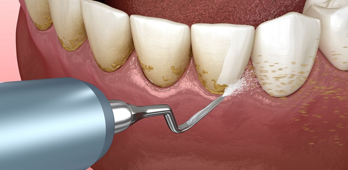 Lấy vôi răng có đau không, có ảnh hưởng tới men răng không?