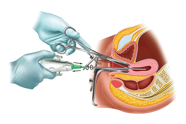 Rối loạn kinh nguyệt sau hút thai là một biểu hiện thường gặp do tác động làm ảnh hưởng đến hoạt động tử cung