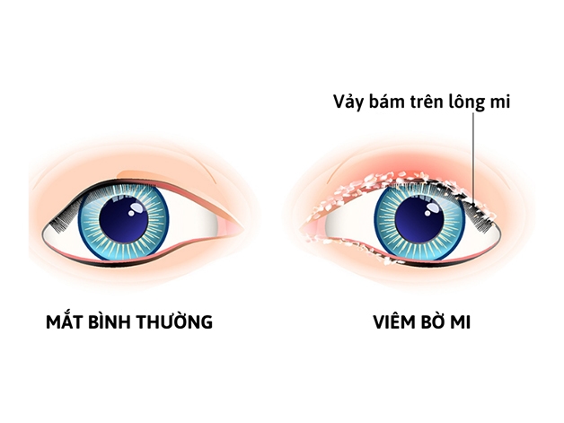 viêm bờ mi